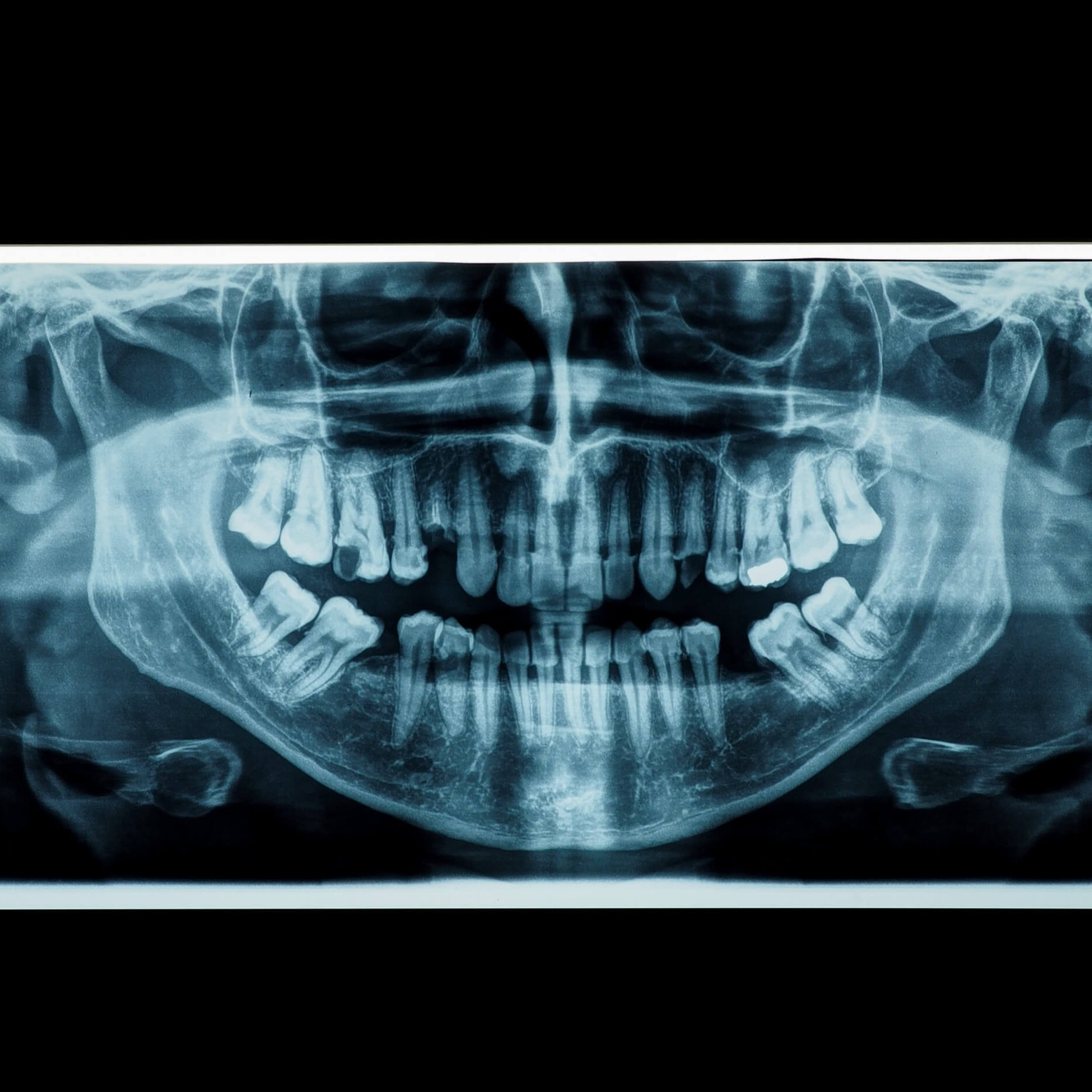 RTG zębów